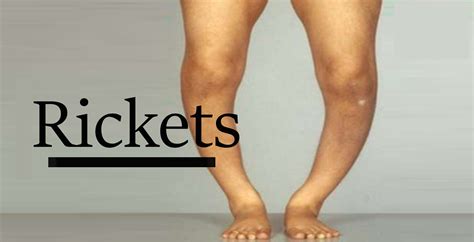 Don't Ignore These Shocking Symptoms of Rickets - You May Have It Without Realizing!
